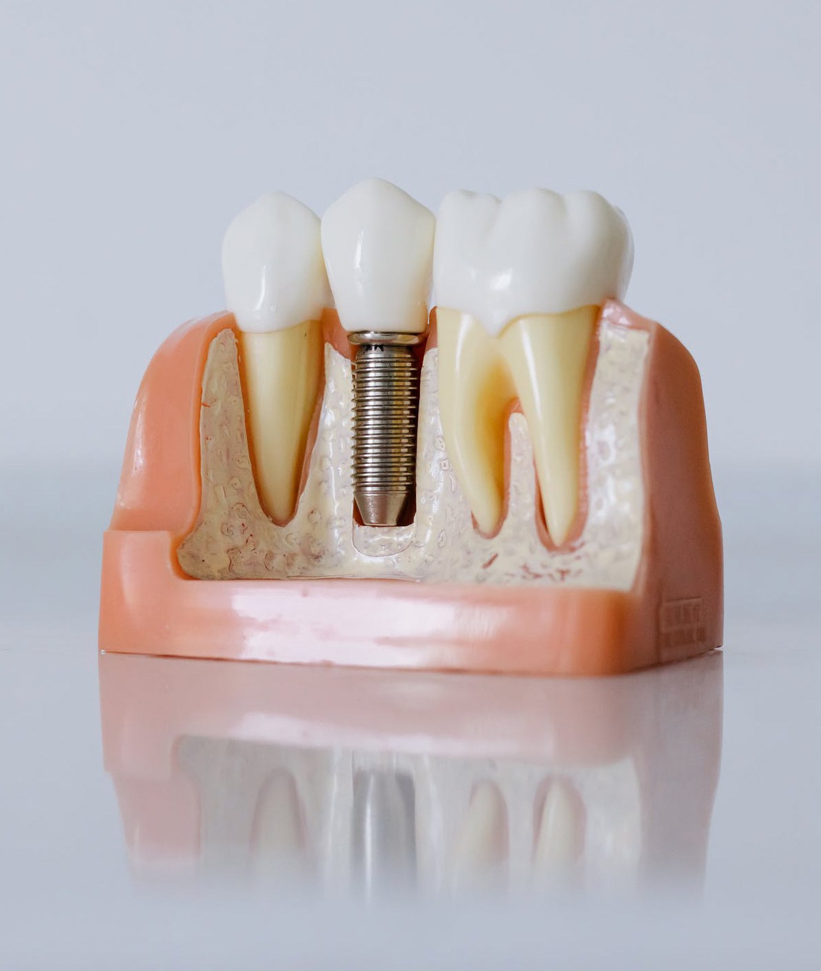 What Happens When You Get a Crown? Robina Town Dental